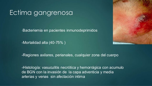 ectima gangrenosa